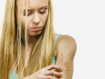 Dermatite atopica e prurigo nodularis: una nuova opzione terapeutica