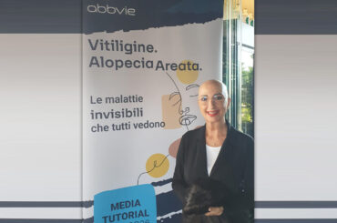 Alopecia e vitiligine: un nuovo farmaco per due malattie dermatologiche