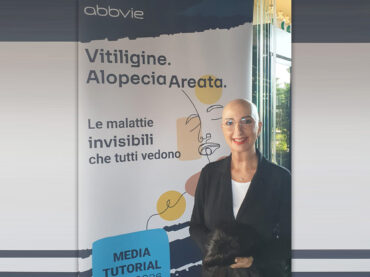 Alopecia e vitiligine: un nuovo farmaco per due malattie dermatologiche