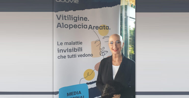 Alopecia e vitiligine: un nuovo farmaco per due malattie dermatologiche