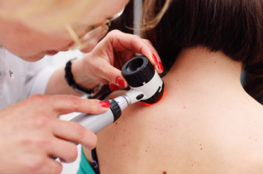 Vaccino personalizzato contro il melanoma