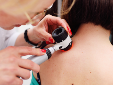 Vaccino personalizzato contro il melanoma